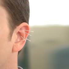 Resources of Physiotherapy treatment: Acupuncture Therapy Resources